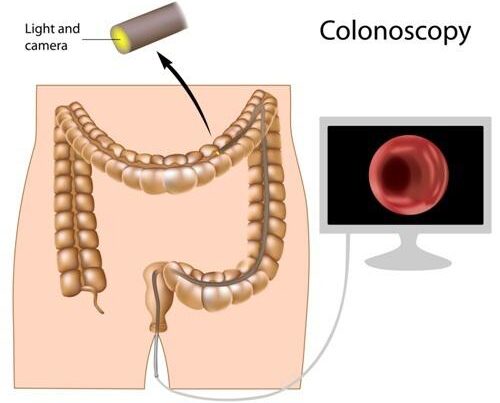 Colonoscopy louisville ky