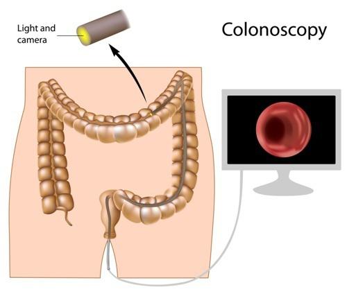 Colorectal Cancer Screening at 45