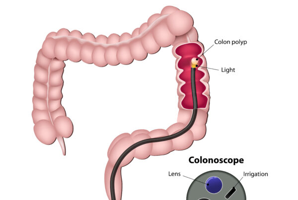 a diagram of a colonoscopy