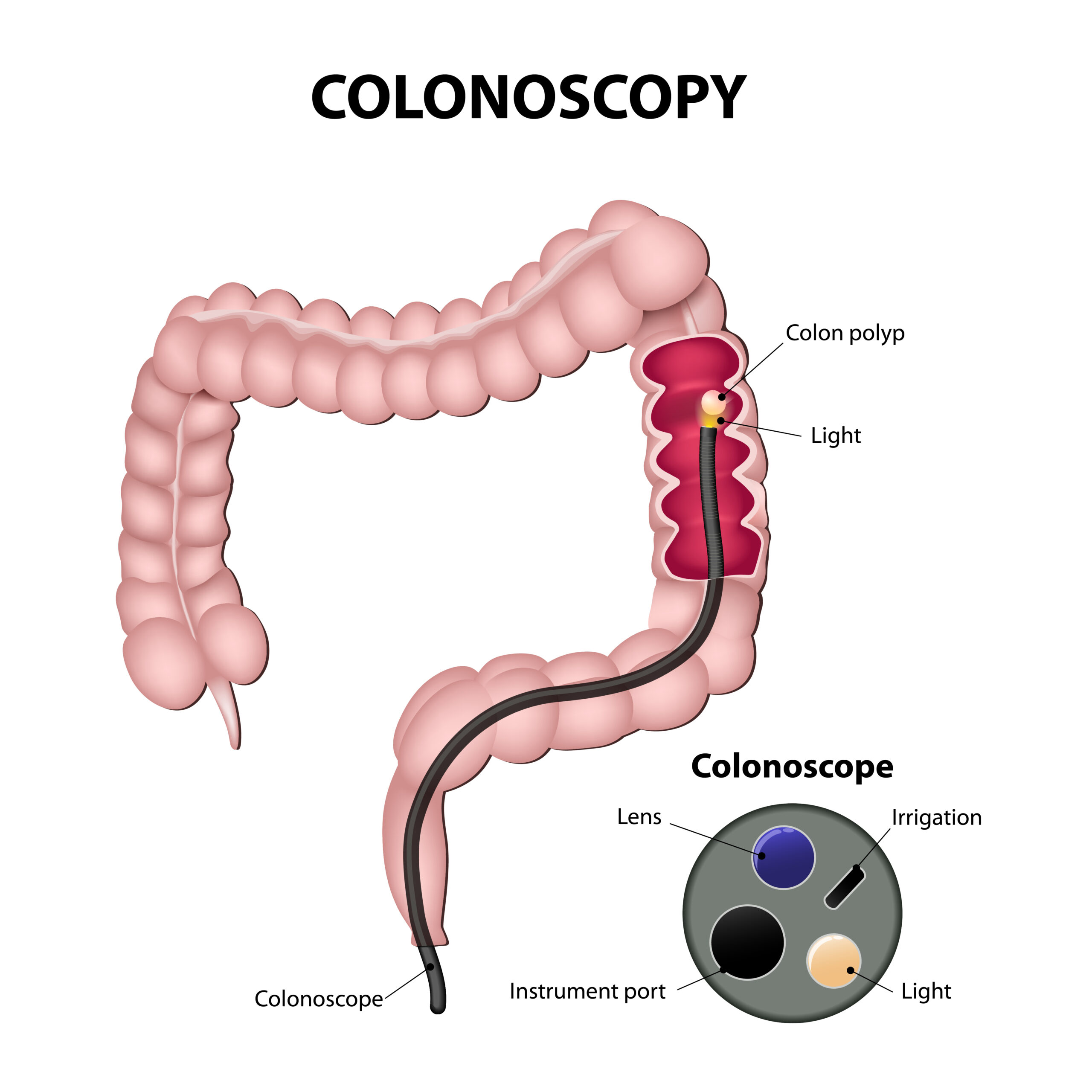 Colonoscopy: What to Expect