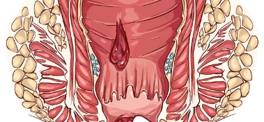 hemorrhoid treatment