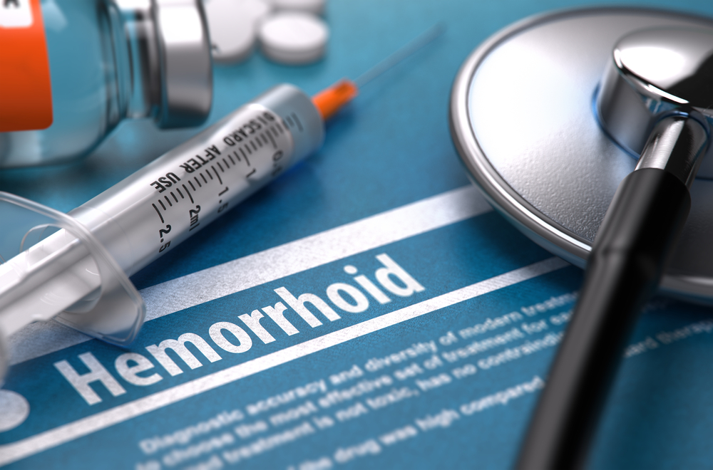 Types of Hemorrhoids: An Overview