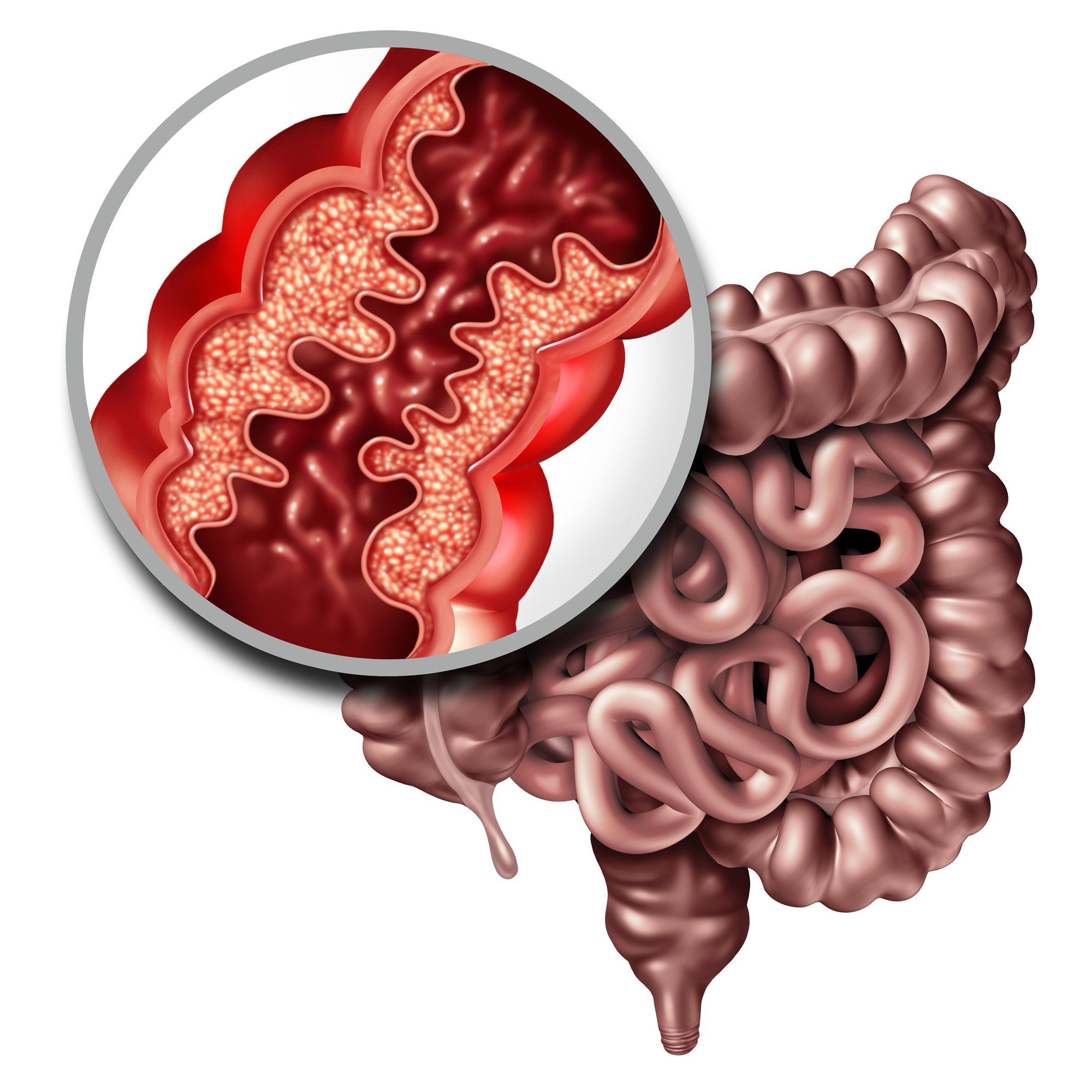 Understanding Crohn’s Disease – An Overview